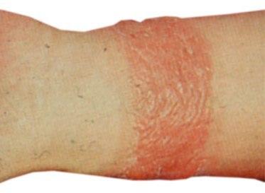 Catrame di betulla a psoriasi palmar e psoriasi di piantatore
